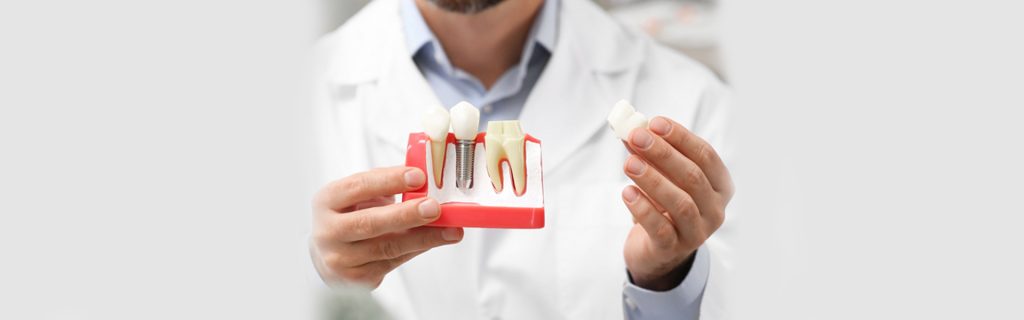 Brantford Dentist explain the dental implant procedure help of implant model