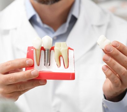 Is Dental Implant the Best Solution for Tooth Loss? Unveiling the Truth