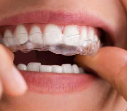 How Much Time Is Required to Get Comfortable with Invisalign?